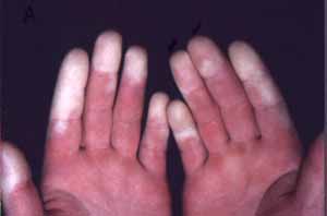 Picture of a Reynaud's phenomenon - Repetitive Stress Injury