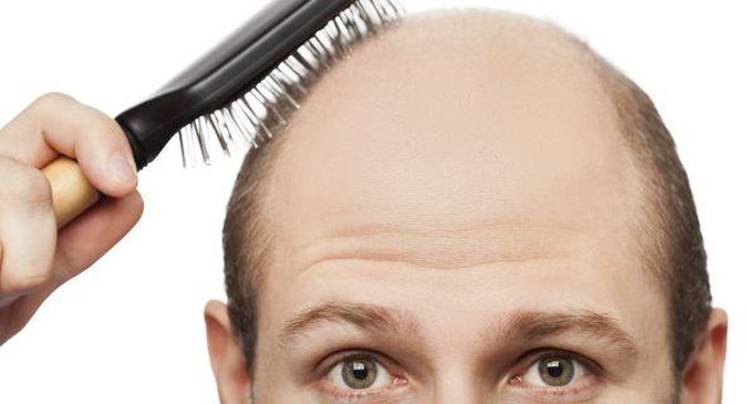 Factors that contribute to a failed hair transplant