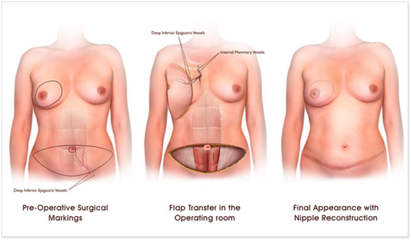 Breast Reconstruction Surgery
