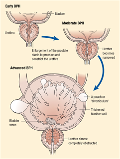 benign prostatic hyperplasia (BPH)
