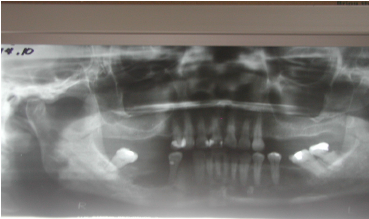 figure-1-panoramic-radiograph