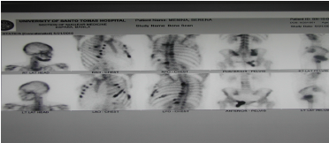 figure-2a-bone-scintigraphy