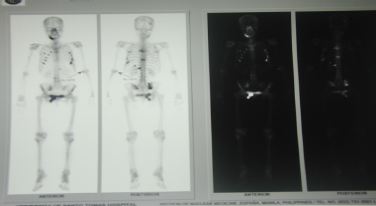 figure-2b-bone-scintigraphy