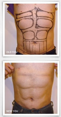 Abdominal Etching - From Flab to Fab