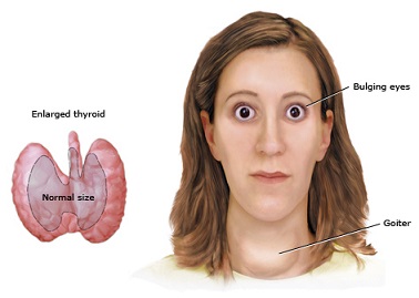 Signs and symptoms of Hyperthyroidism (Overactive Thyroid))