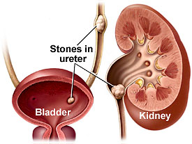 Kidney stones