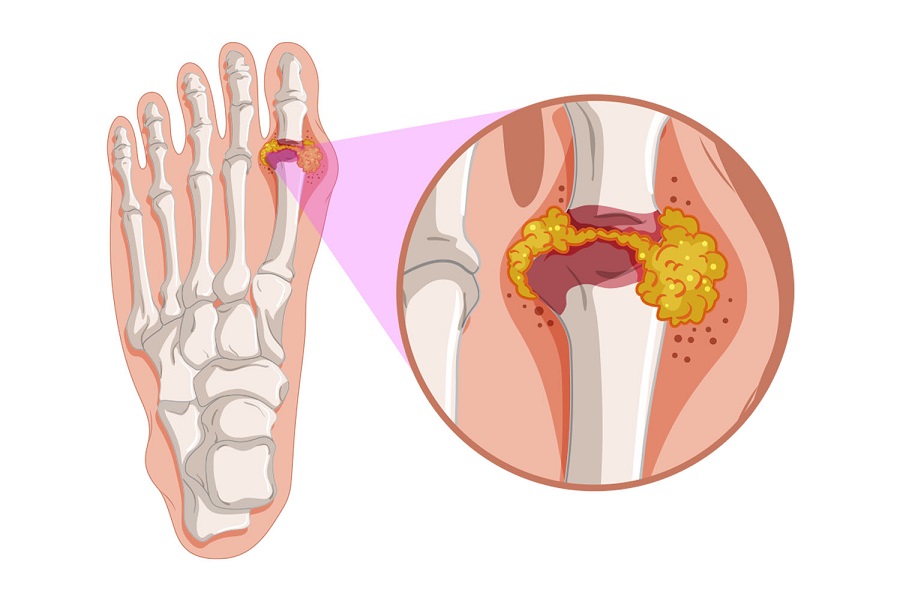 Preventing Gout