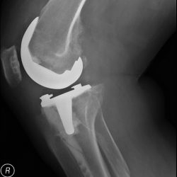 Right Knee Post-Surgery Lateral Implant