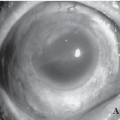 Figure A - Sympathetic Ophthalmia in an Infected Post-Scleral Buckling Eye