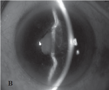 Figure B - Sympathetic Ophthalmia in an Infected Post-Scleral Buckling Eye