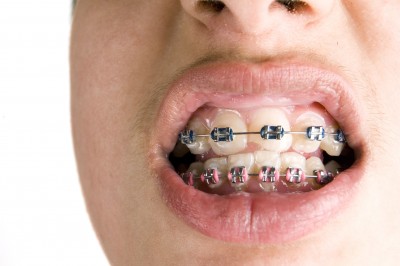 Best Devices For Cleaning Dental Braces