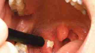 A tonsillolith half exposed on tonsil
