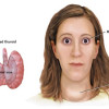 Overactive Thyroid image