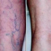 Troubled by Unsightly Spider Veins? Try Laser Treatment! image