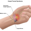 What Are The Types Of Repetitive Stress Injury? image