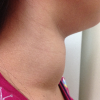 Diabetic Ketoacidosis In A Patient With Thyroid Storm: A Case Report image