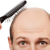 Alopecia Areata - an autoimmune condition image