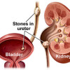 Kidney Stones: Symptoms, Causes, Types, Treatment image