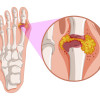 Preventing Gout: Types of Food to Avoid, Lessen, and Increase image