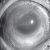 Sympathetic Ophthalmia in an Infected Post-Scleral Buckling Eye image