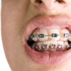 The Best Devices For Cleaning Braces image