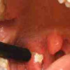 How to Get Rid of Tonsil Stones image