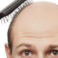 Factors that contribute to a failed hair transplant