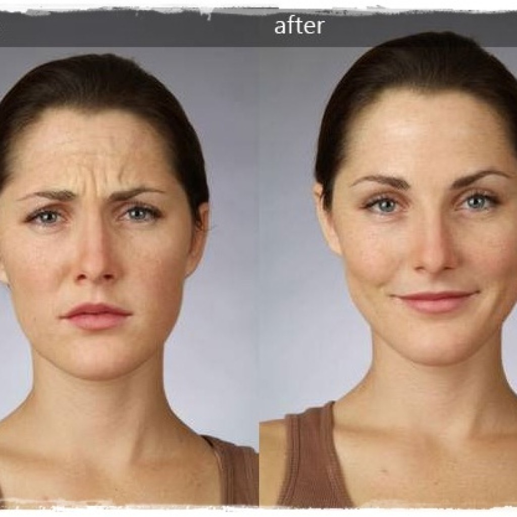 Асимметрия лица после ботокса фото до и после